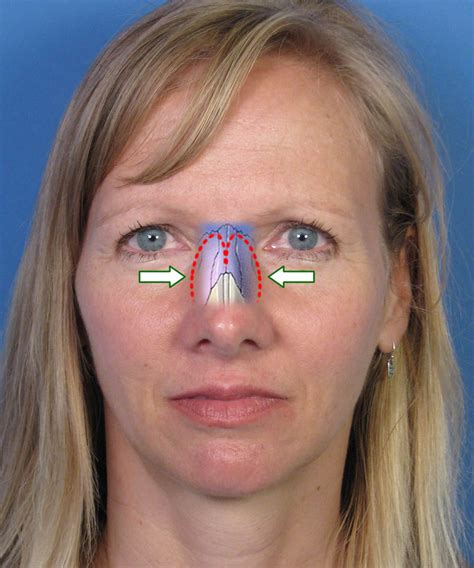 Sudden indentation on nose - 8. If your nose hooks down at the end: This relates to the last couple of years in your 40s. "If your nose turns downs, it means in the end of your 40s, you're meant to slow down, but if you push ...